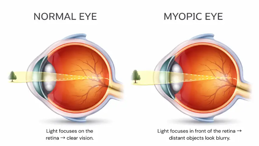 Myopia
