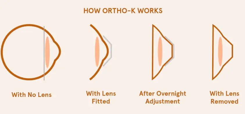 How Does Ortho-K Lens Work