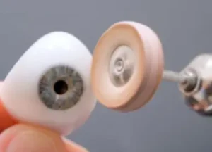 Prosthetic Eye