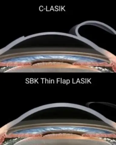 sbk-blade-based-lasik